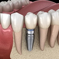 Animated smile with dental implant supported dental crown in  place