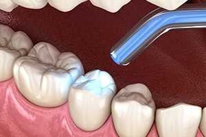 Animated smile during dental bonding treatment