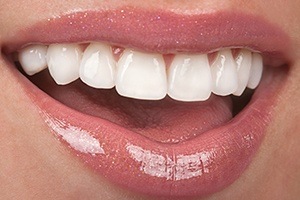 Closeup of bright smile after teeth whitening
