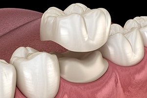 Animated smile during dental crown placement