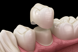 Animated smile during dental crown placement