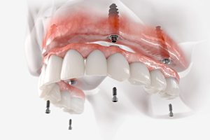 Illustration of implant dentures for upper dental arch