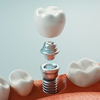 Animated smile during dental implant placement