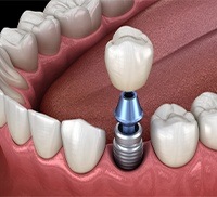 Animated smile during dental implant supported dental crown placement