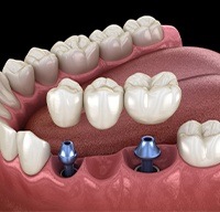 Animated smile during dental implant supported fixed bridge placement