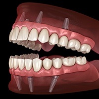 Animated smile during dental implant supported denture placement