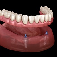 Animated smile during mini dental implant placement