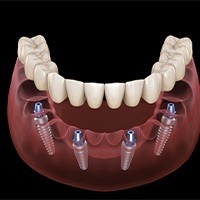 Animated smile during all on four dental implant placement