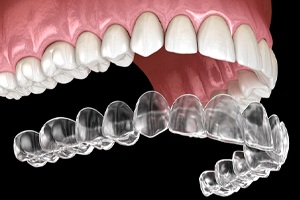 Illustration of Invisalign® aligner being placed on the teeth