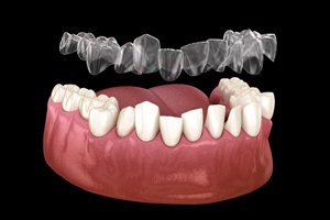 Illustration of Invisalign® being placed on crooked teeth