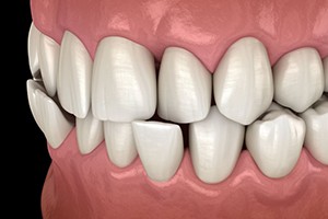 Illustration of a crossbite against dark background