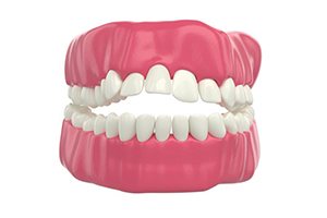 Illustration of an open bite pictured against white background