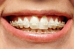 Closeup of teeth during six month smiles treatment