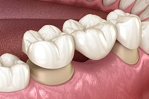 Animated smile during dental crown supported fixed bridge placement