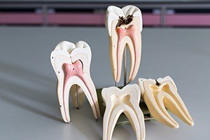 Model of healthy tooth compared to tooth in need of root canal therapy