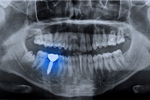 Dental implant highlighted on X-ray