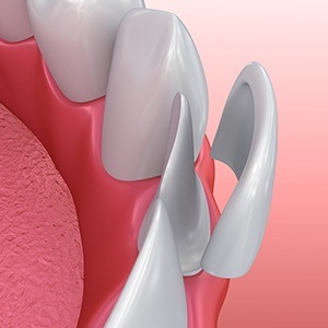 Animated smile during porcelain veneer placement