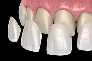 Animated smile showing porcelain veneer placement