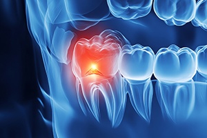Digital illustration of inflamed wisdom tooth