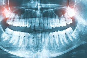 X-ray with two impacted wisdom teeth highlighted in upper arch