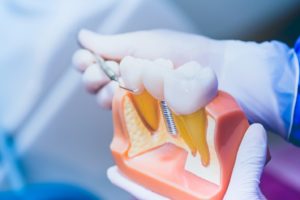Dentist using model to explain sensitivity in a dental implant in Westborough