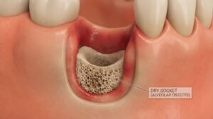 Illustration of dry socket at the site of a tooth extraction